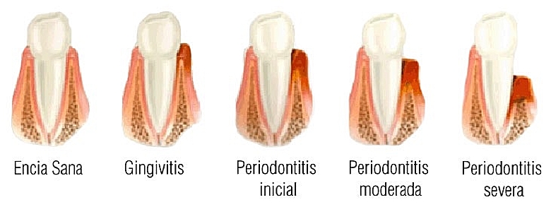 Enfermedad de las encías en Fuenlabrada
