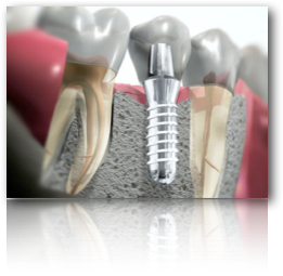 Implantes dentales 2