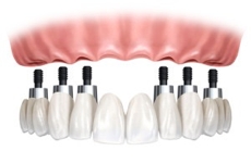 Prótesis dentales en Fuenlabrada